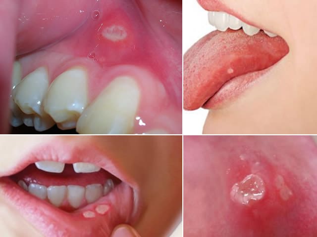 Afta in bocca: sintomi, cause e rimedi